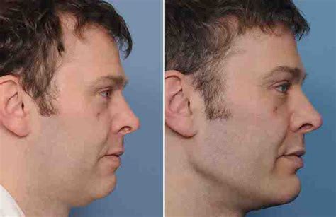 Male Custom Infraorbital Malar And Jawline Implant Results Side View Dr