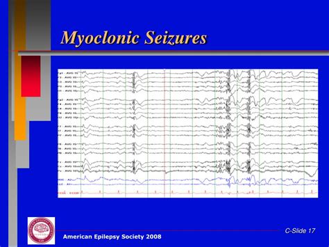 Ppt Clinical Epilepsy Powerpoint Presentation Free Download Id4397765