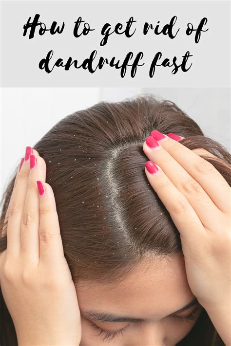 Say Goodbye To Dandruff The Ultimate Guide On How To Get Rid Of