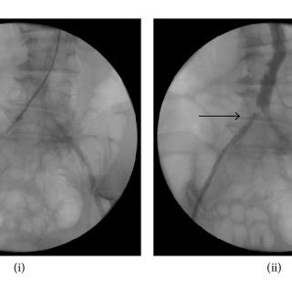 Pdf Endovascular Management Of Aorta Iliac Stenosis And Occlusive