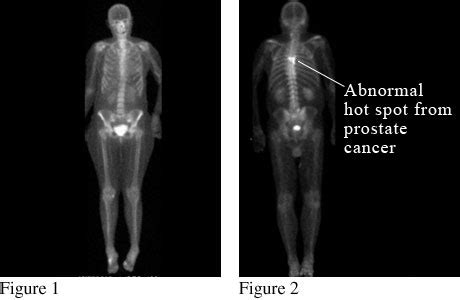 Bone Scan of the Spread of Prostate Cancer Video & Image