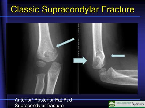 Ppt Pediatric Fractures Powerpoint Presentation Free Download Id