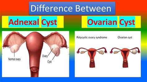 Difference Between Adnexal Cyst And Ovarian Cyst Youtube