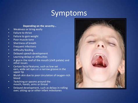 Di George Syndrome Dgs