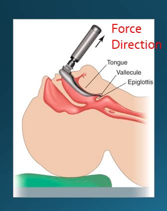 Airway Management Flashcards Quizlet