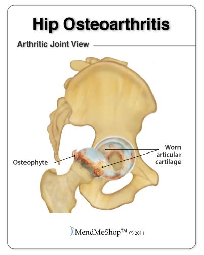 Managing Hip Osteorthritis