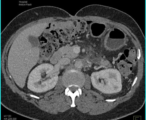 Cta With Bypass Grafts From Aorta To Superficial Femoral Arteries Sfas