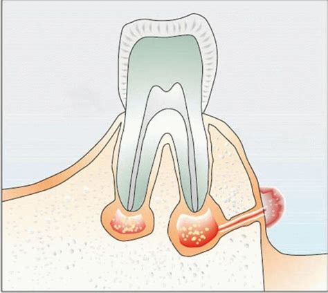 Fístula na gengiva causas tratamento de uma fístula dental na boca