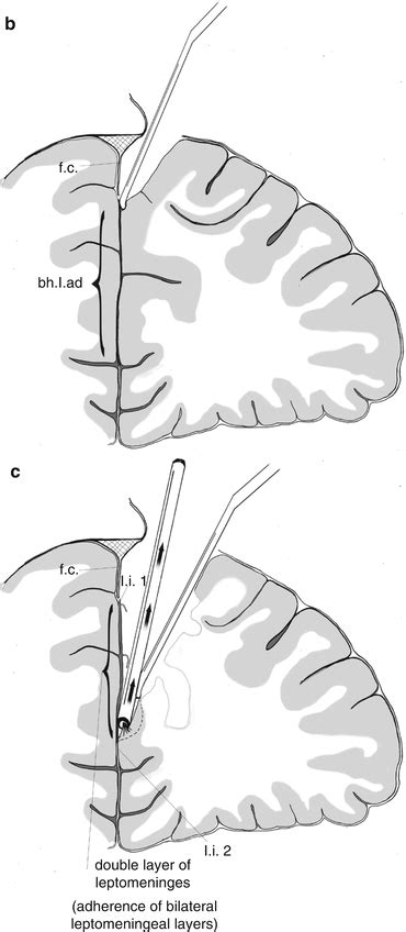 Frontal Lobe Surgery | Neupsy Key