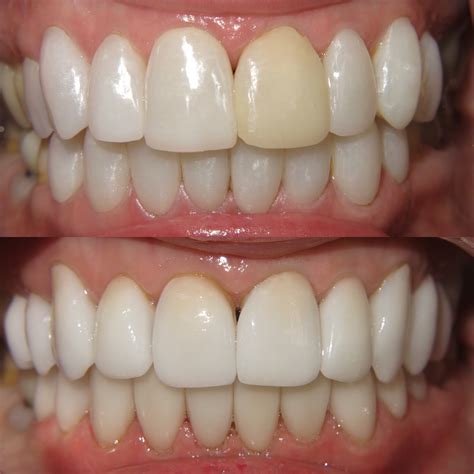 How Well Does Led Teeth Whitening Work