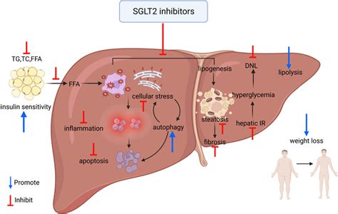 Overview Of The Mechanism Of Improvement Of NAFLD By SGLT 2 Inhibitors