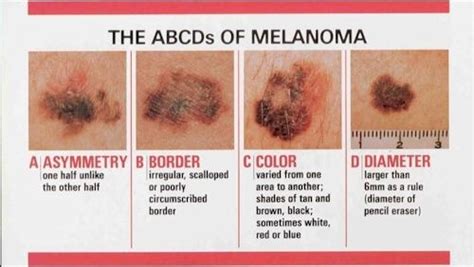 Treatment Of Skin Lesions At Brightnewme