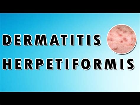 Dermatitis Herpetiformis Treatment Causes And Symptoms Dermatology