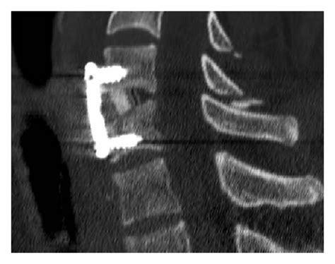 A B And C Postoperative CT Scan Demonstrating A Good