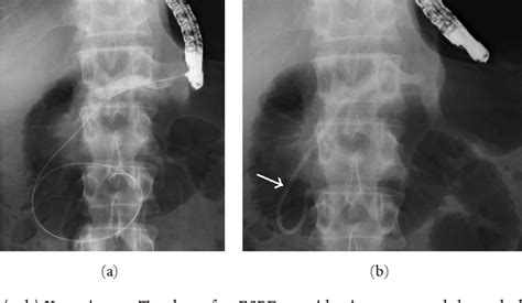 Figure 1 From Endosonography Guided Pancreatic Duct Drainage For