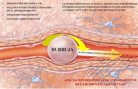 Embolismo Gaseoso Medicina Hiperb Rica