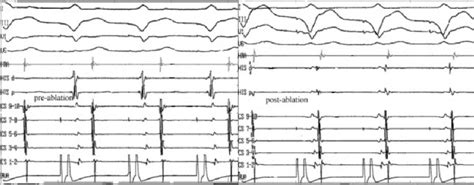 Surface Leads And Intracardiac Electrograms During Ventricular Pacing