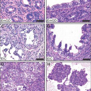 Precursor Lesions And Progression Model Of Tumour Formation A Normal