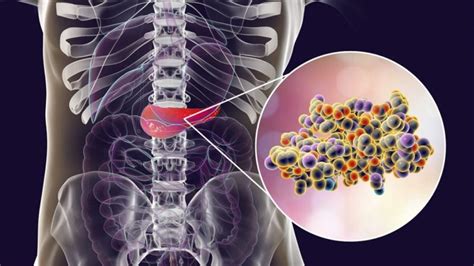 Por Qué El Cáncer De Páncreas Es El Más Difícil De Prevenir Y Diagnosticar El Heraldo De San