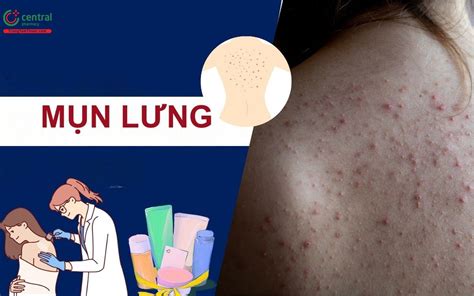 Nguyên Nhân Và Cách Trị Dứt điểm Mụn Lưng Chuẩn Y Khoa Cho Cả Nam Và Nữ