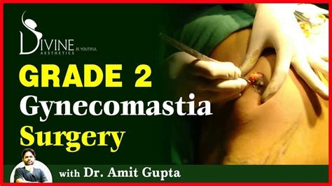 Gynaecomastia Grade 2 Surgery With Dr Amit Gupta Plastic Surgeon Youtube