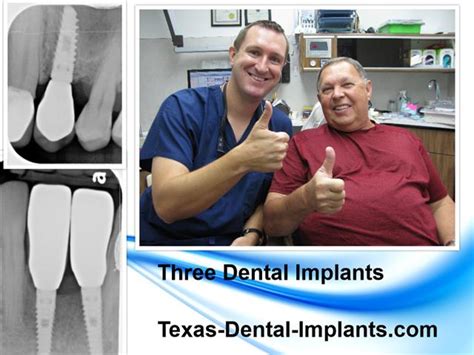 Multiple Dental Implants The Pasadena Dentist Michael Nugent Dds