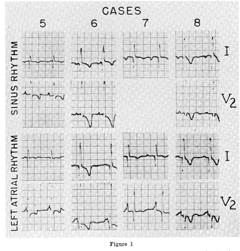 Figure 1 From Left Atrial Ectopic Rhythm In Mirror‐image Dextrocardia