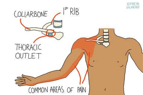 Thoracic Outlet Syndrome Symptoms Causes And Types