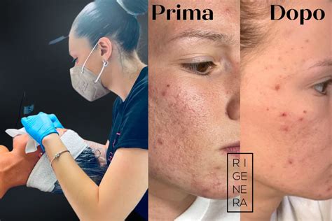 Pulizia Del Viso Treviso Efficace Per Pelle Grassa E Acne