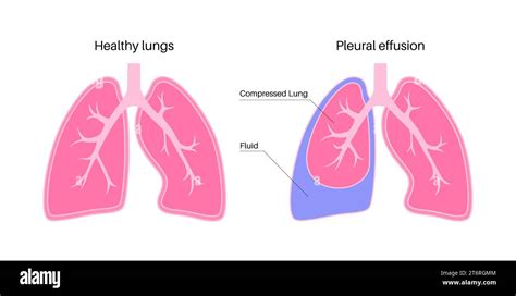 Pleural Effusion Illustration Stock Photo Alamy