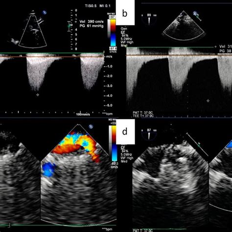 Preoperative Transthoracic Echocardiography Showed The Descending Aorta