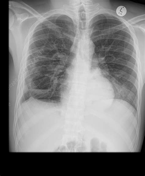 Ct Scan Chest Axial View Download Scientific Diagram