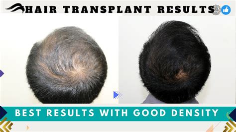 Hair Transplant In Patna Best Surgeon Clinic Results Cost Of Hair