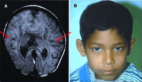 Holoprosencephaly Brain