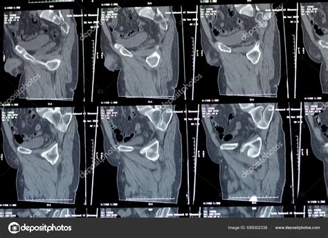 Cairo Egypt November Non Enhanced Scan Pelvis Revealed Grade