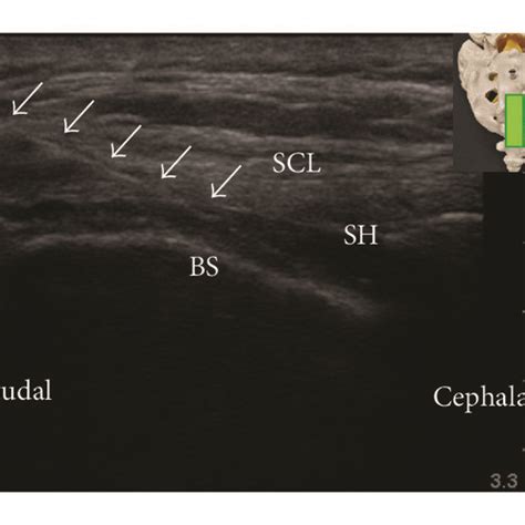 Pdf Caudal Epidural Block An Updated Review Of Anatomy And Techniques