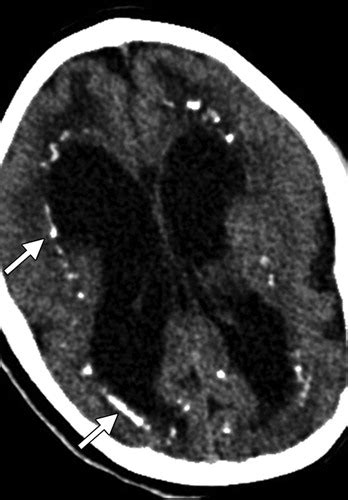 Cmv Periventricular Calcification