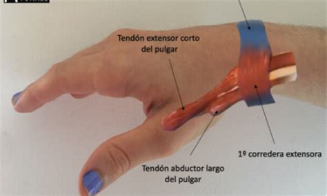 Tendinitis De De Quervain Dr Ngel Torres