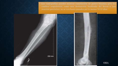 Osteomielitis Aguda Hematógena En Niñospptx