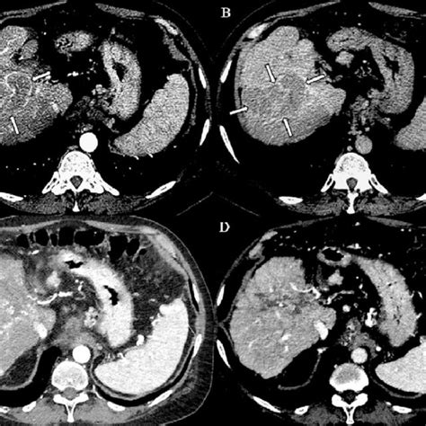 A B Computed Tomography Images Nodule In The Liver Segments V Viii