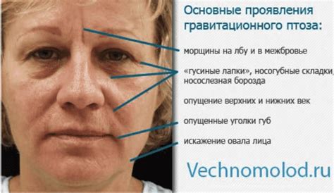 Гравитационный птоз