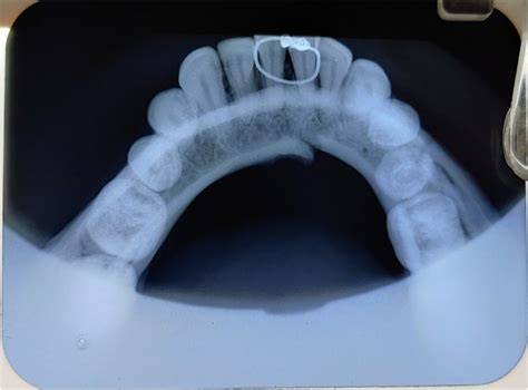 Novel Method For Mandibular Fracture Reduction Using Inter Fragmentary Screw Report Of A