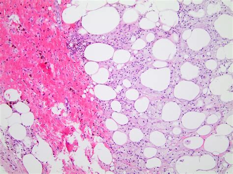 Pathology Outlines Fat Necrosis