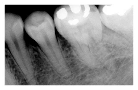 Preoperative Radiograph Showing Three Separate Roots Of Mandibular