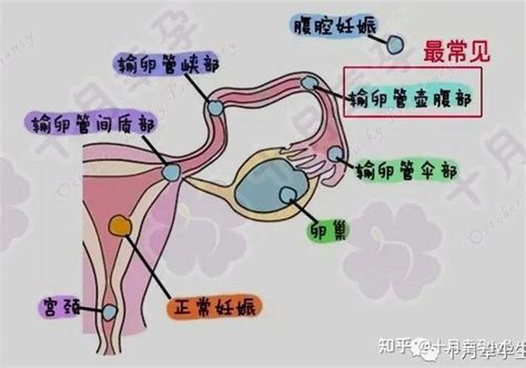 【十月幸孕ivf】做试管会不会宫外孕？ 知乎