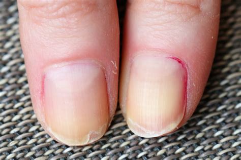 Pourquoi Mes Ongles Sont Cassants Les Causes Et Les Solutions