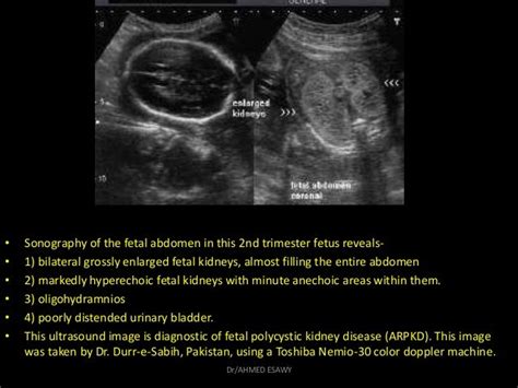 10 Fetal Urinary Tract Dr Ahmed Esawy