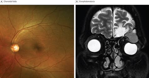 Frontal Sinus Mucocele Diagnosed By Fundus Examination And B Mode