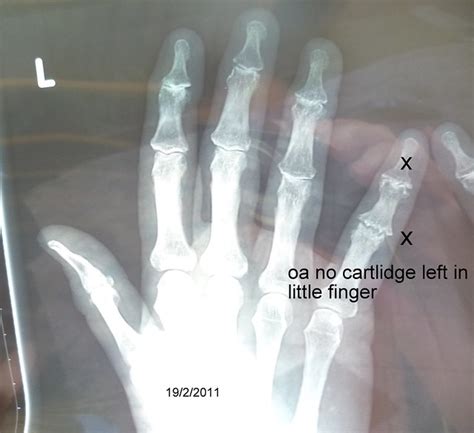 Osteoarthritis fingers and wrists | Flickr - Photo Sharing!