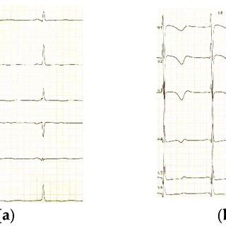 Twelve Lead Electrocardiogram With Limb Leads A And Chest Leads B